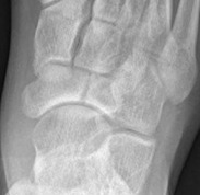 Navicular Stress Fracture Displacing